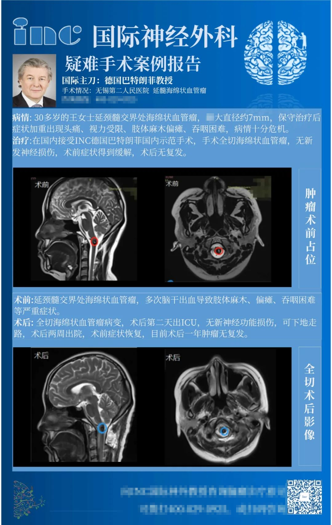 海绵状血管瘤手术案例