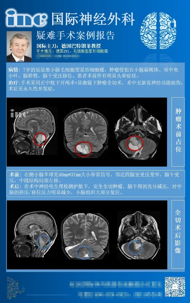 毛细胞型星形细胞瘤—级是良性