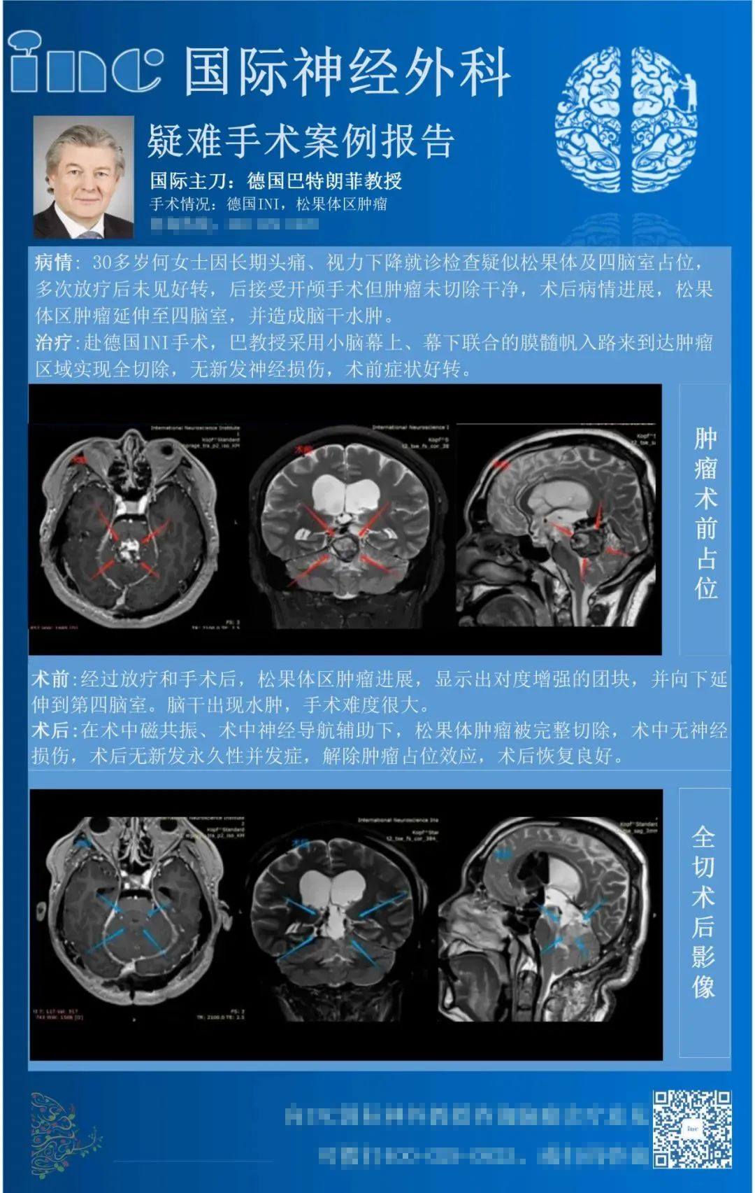 较大松果体区肿瘤