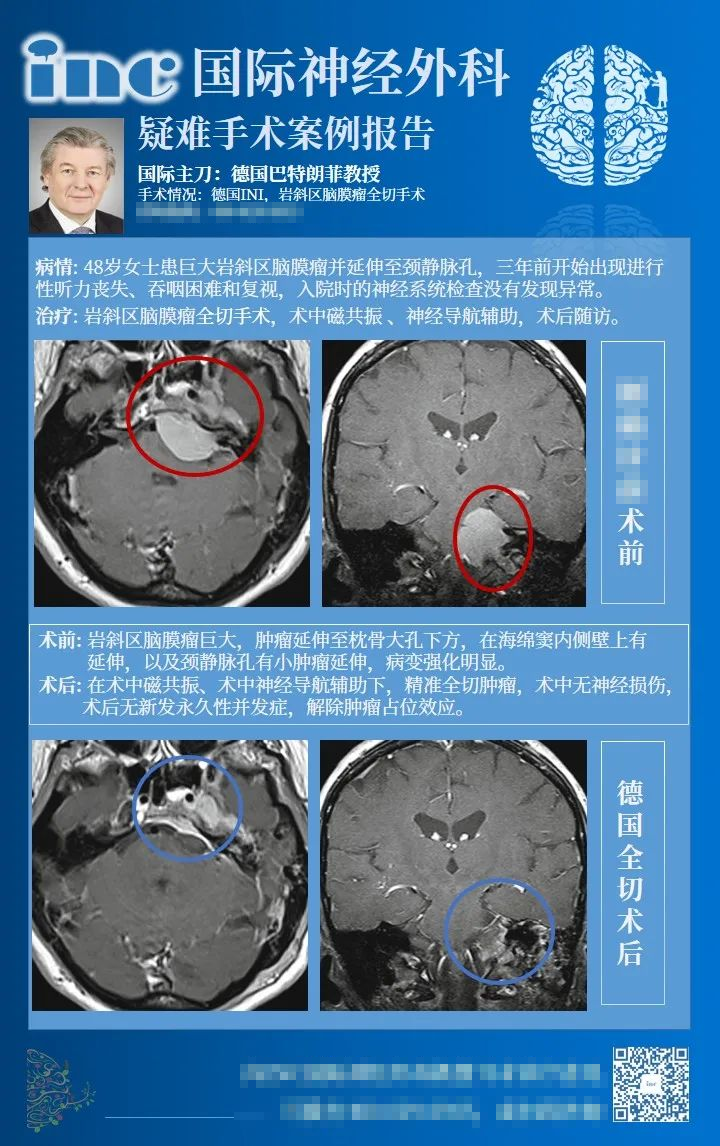 岩斜区脑膜瘤能治愈吗？岩斜区脑膜瘤岩斜区脑膜瘤成功案例