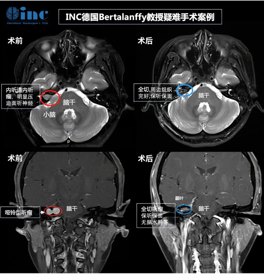 听神经瘤案例