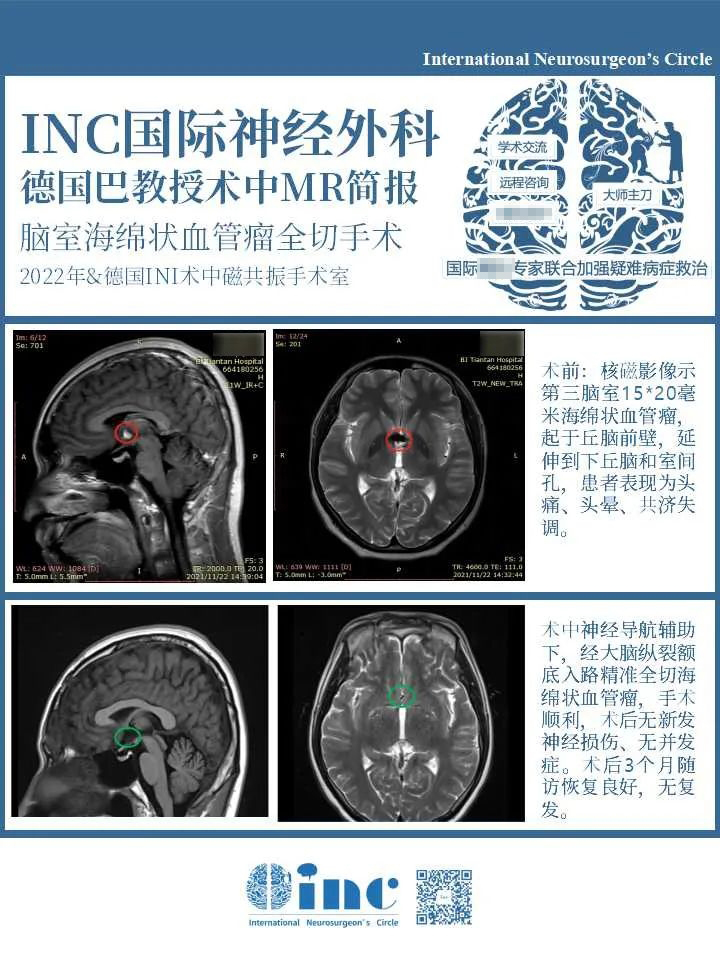 脑室内海绵状血管瘤怎么治疗？脑室内海绵状血管瘤患者手术案例分享