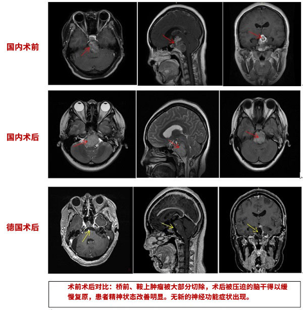 脊索瘤手术