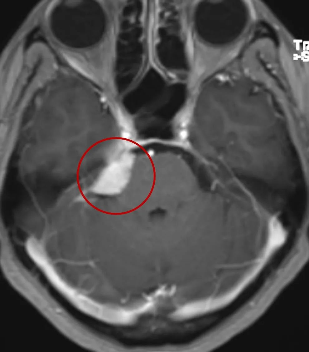CPA桥小脑角区脑膜瘤