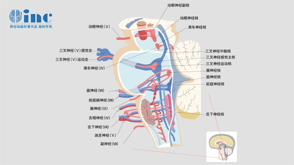 脑干海绵状血管瘤