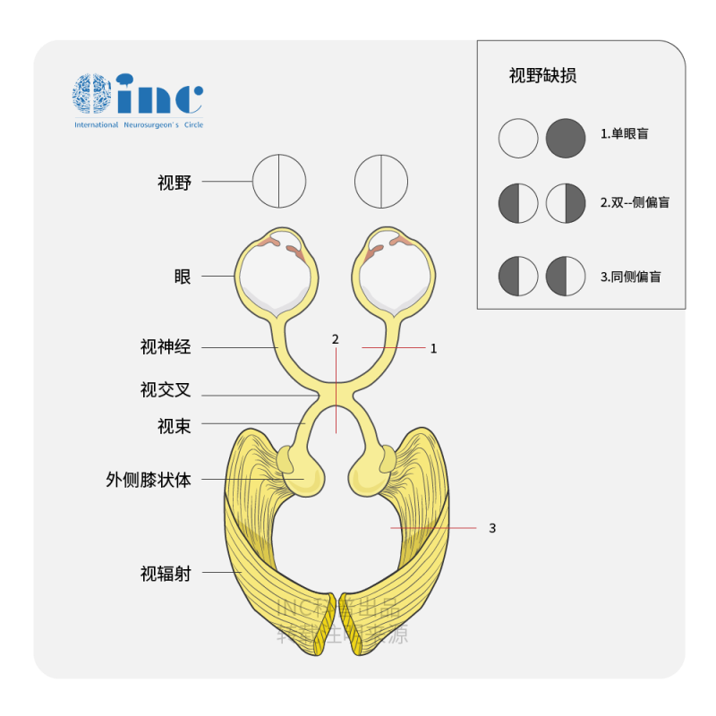 视神经胶质瘤