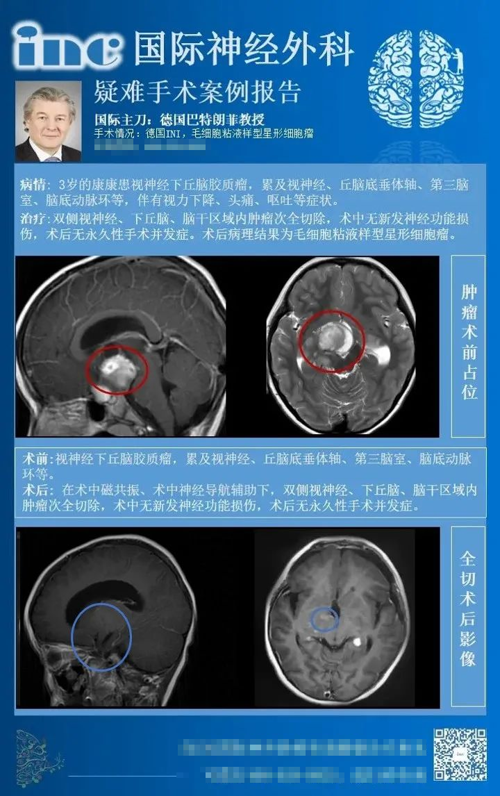 视神经胶质瘤