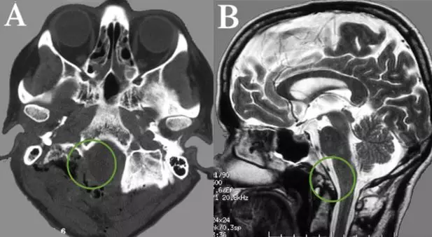 枕骨大孔区脑膜瘤