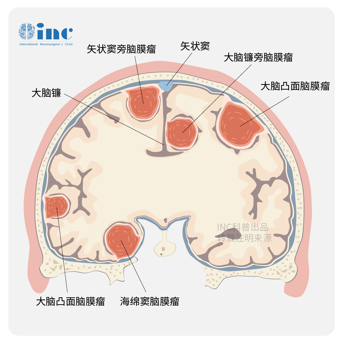 矢状窦脑膜瘤