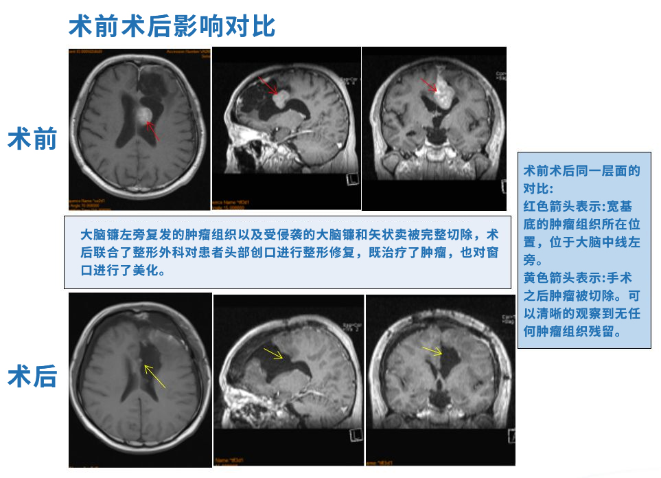 矢状窦脑膜瘤手术