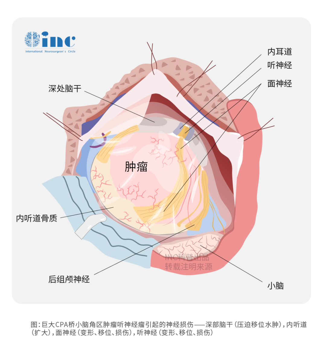 桥小脑角区脑膜瘤能切除干净吗？术后会面瘫吗？