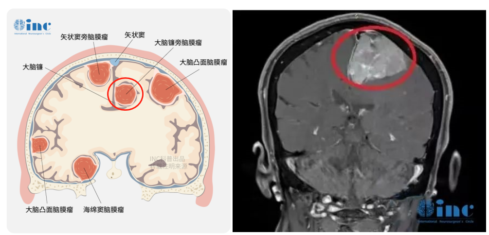 大脑镰旁脑膜瘤