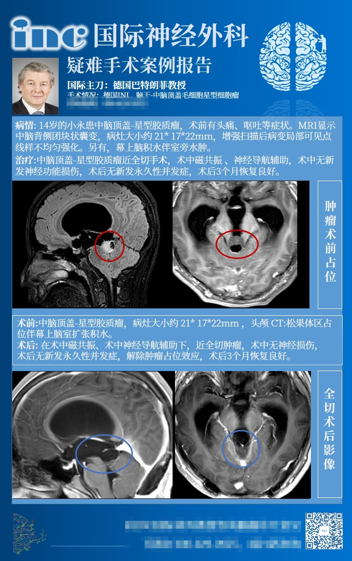 星形细胞瘤治疗方法-2