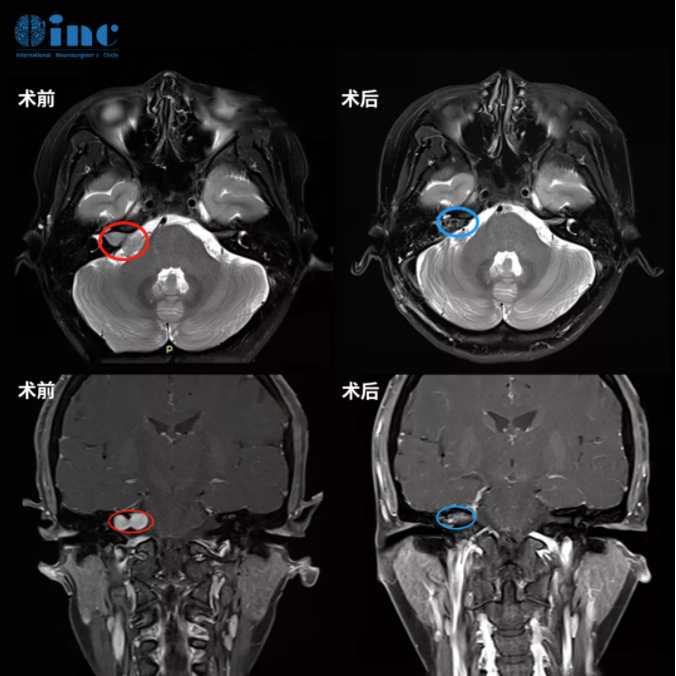 听神经瘤手术