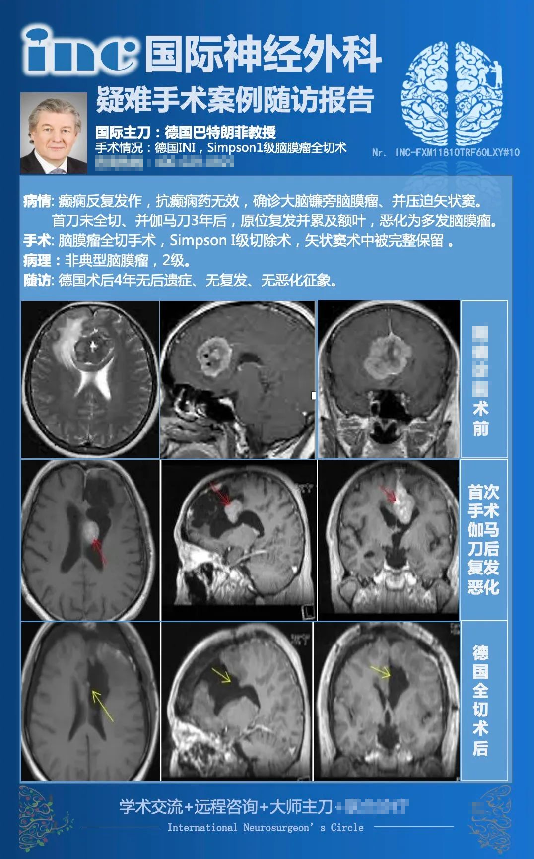 脑膜瘤是良性的吗？得了脑膜瘤不手术放疗可以吗？