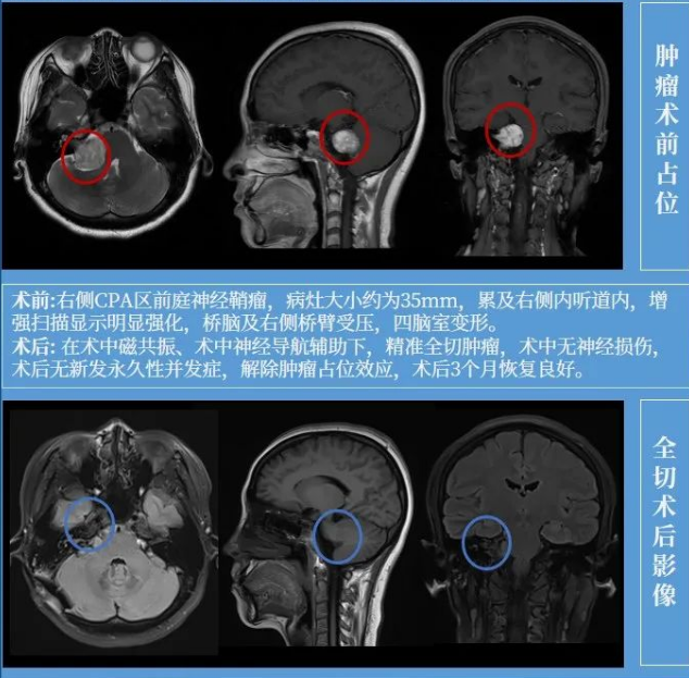 听神经瘤手术患者自述