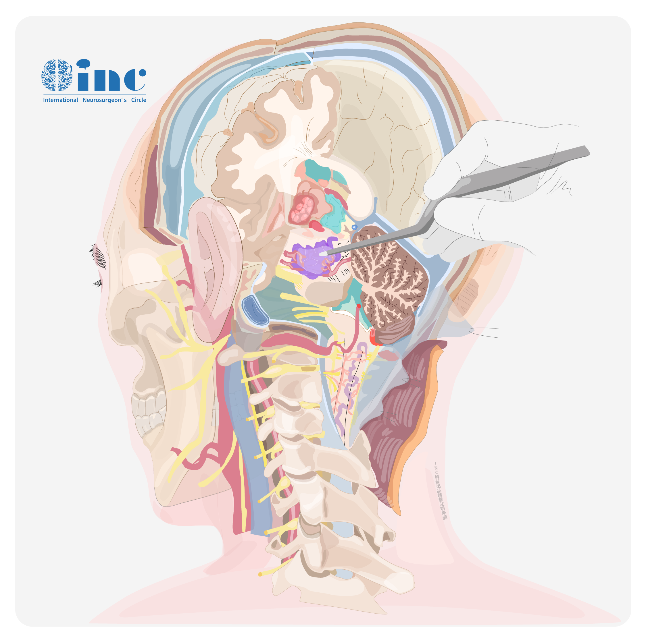 枕骨大孔区脑膜瘤手术