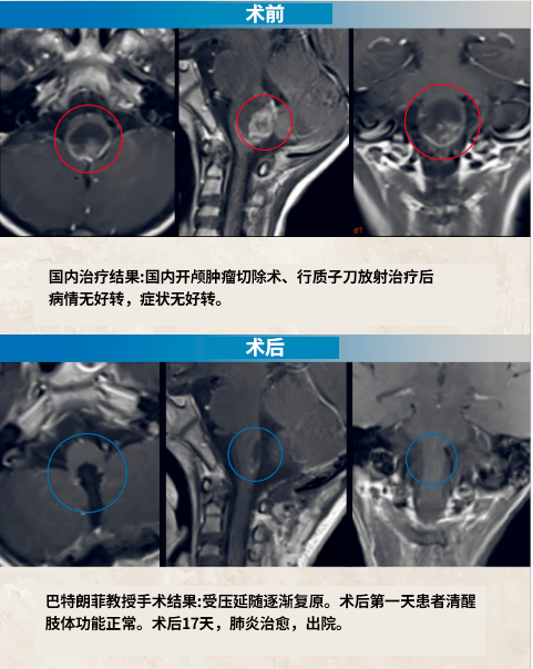 室管膜瘤压迫脑干，还能成功手术吗？