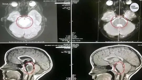 《新英格兰医学杂志》（NEJM）较新综述丨儿童这3大脑瘤生存期有提高吗？如何