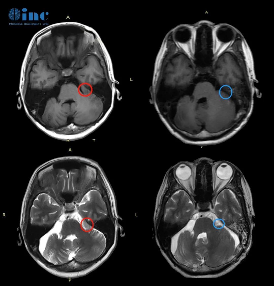 脑桥小脑角区常见的肿瘤,如何从影像来区别?