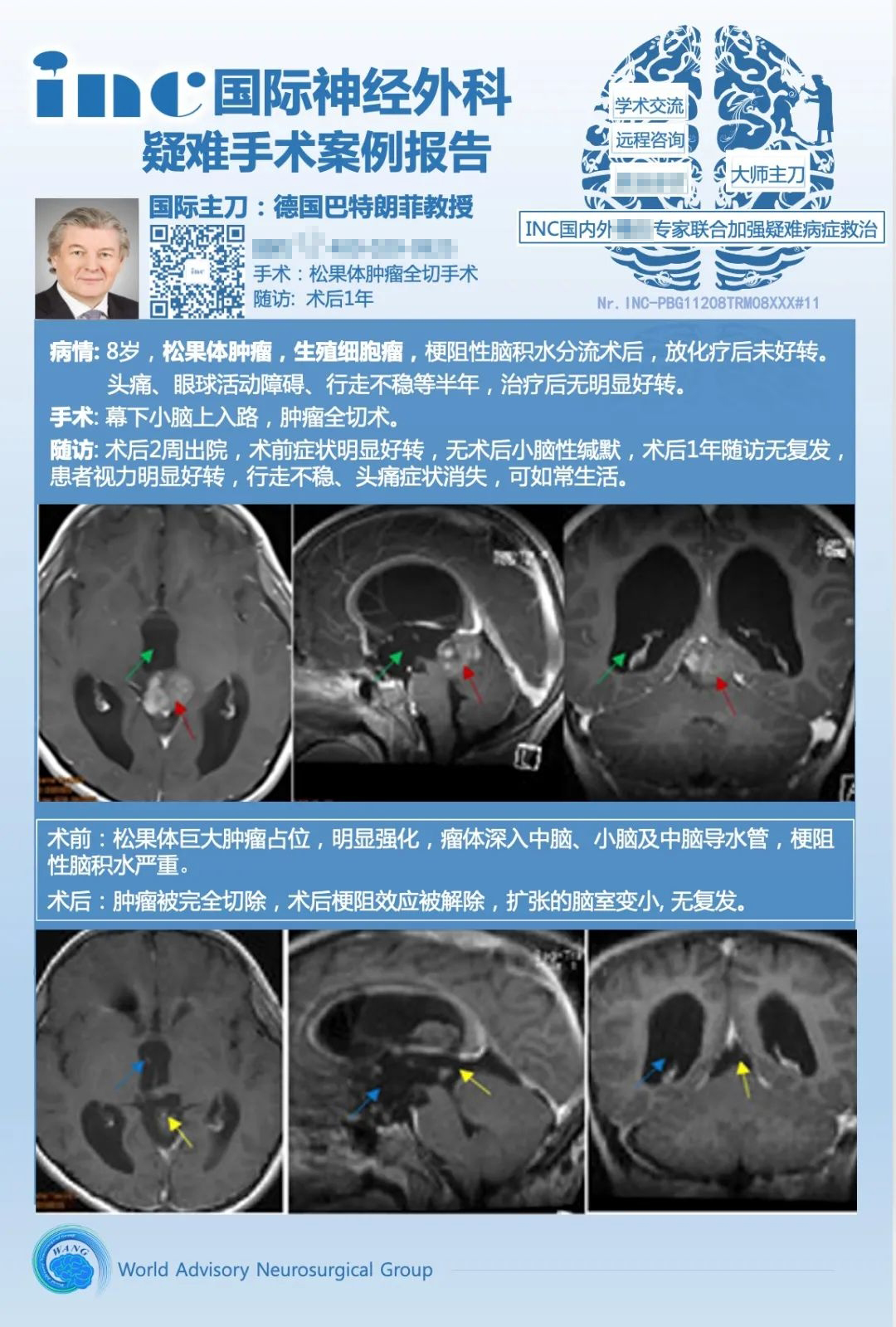 松果体生殖细胞瘤怎么治疗？化疗有用吗？