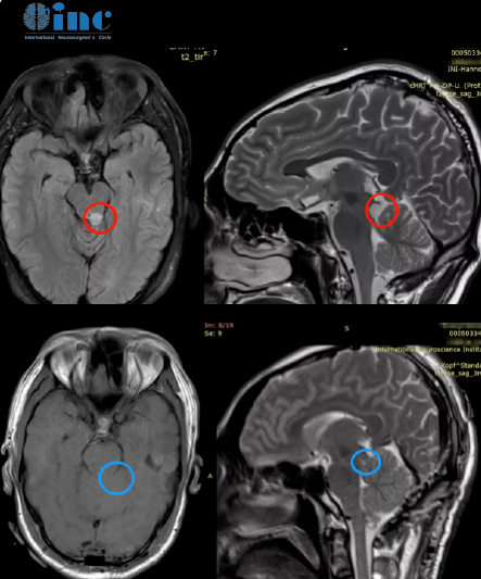 脑干-中脑顶盖胶质瘤患者记实录