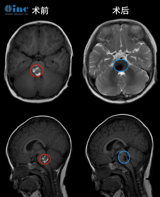 脑干海绵状血管瘤不能手术吗？突破“手术禁区”脑干海绵状血管瘤成功案例分