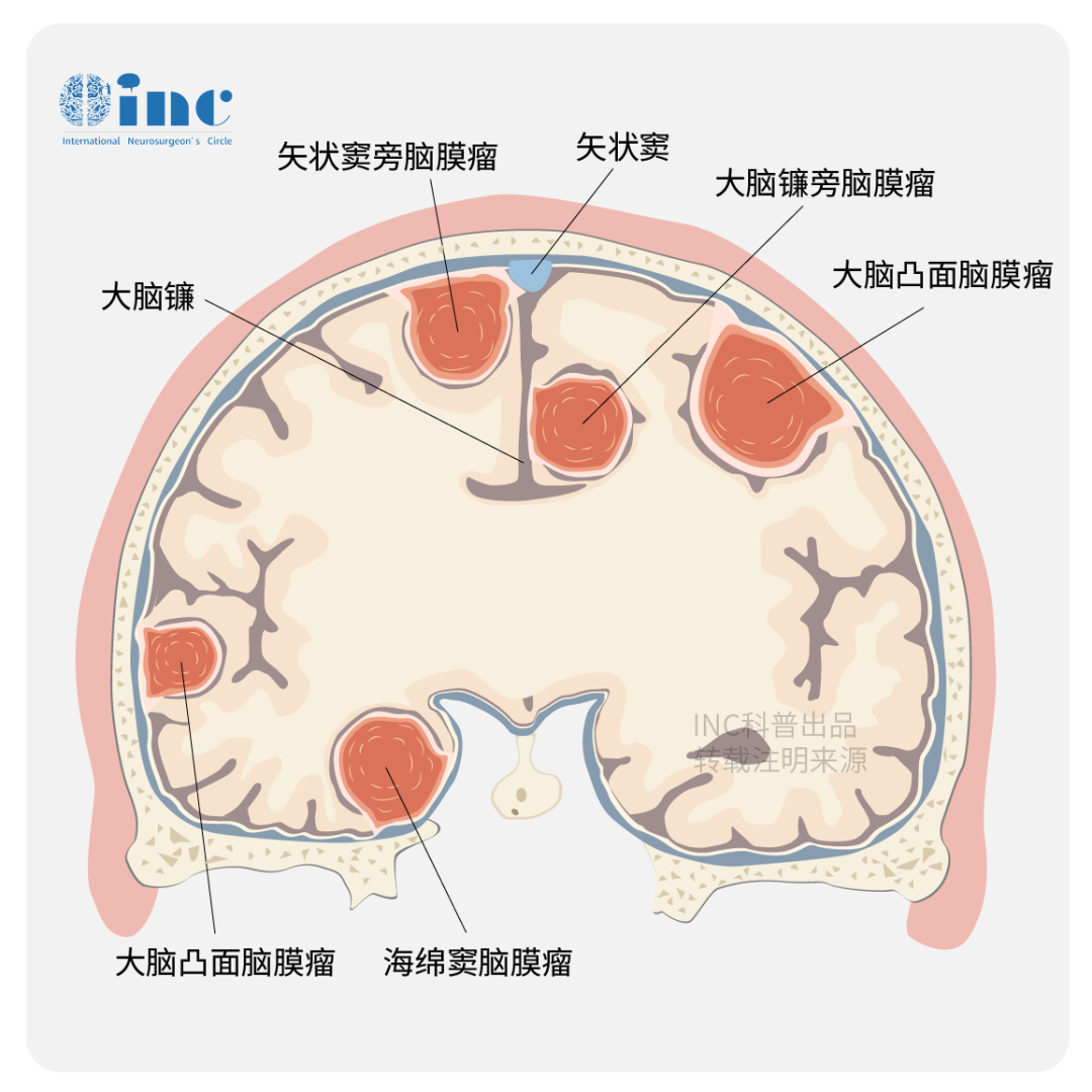 脑膜瘤