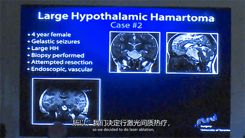 下丘脑错构瘤有哪些症状？下丘脑错构瘤手术后能像正常人吗