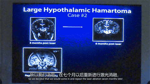 痴笑样癫痫