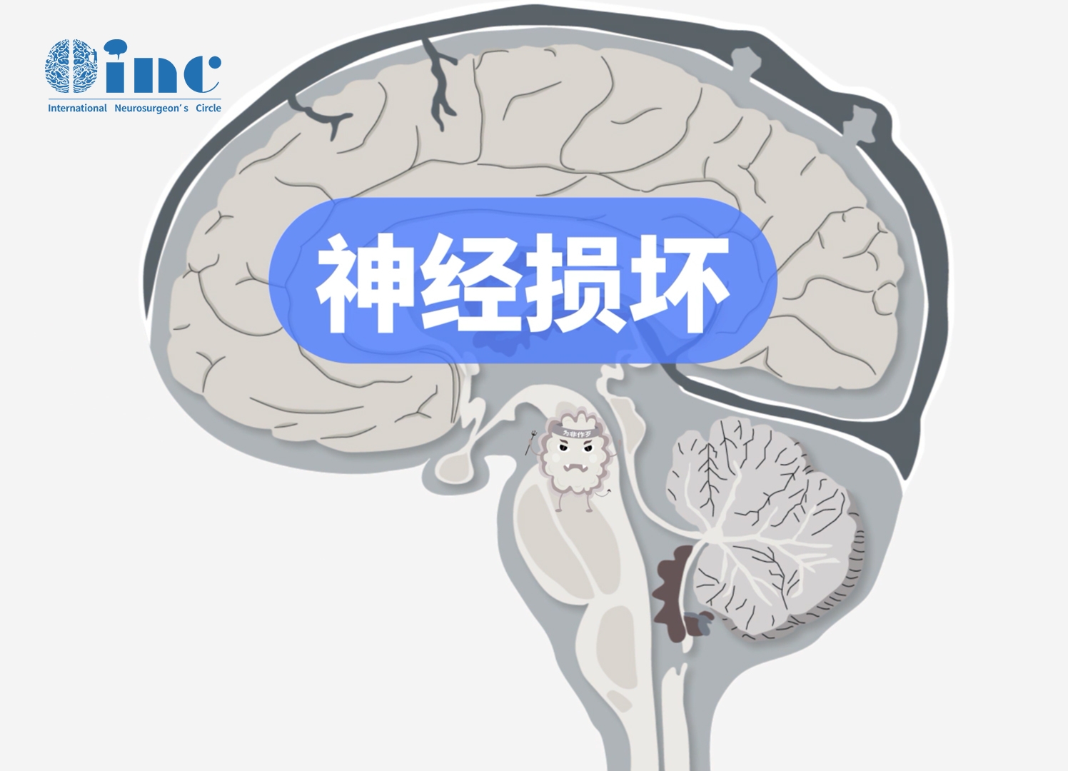 胶质瘤放疗会影响成人的认知功