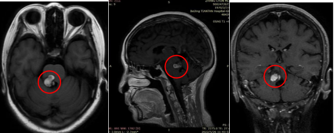 脑干（中脑、桥脑）海绵状血管瘤伴出血，伽马刀失败后还有手术机会吗？