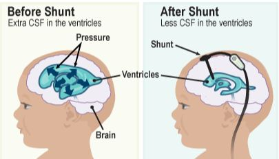 儿童脑积水如何治疗？VP分流术治疗脑积水有哪些并发症风险？