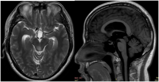 脑干-中脑顶盖胶质瘤可以安全全