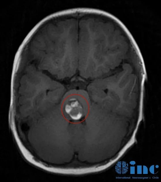 脑干肿瘤