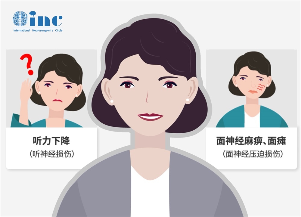 三叉神经鞘瘤手术能治好吗？较大三叉神经鞘瘤全切手术实例交流