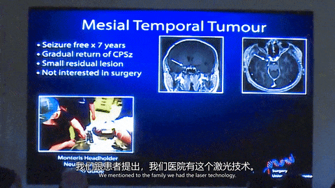 颞叶癫痫一定要手术吗？不开颅