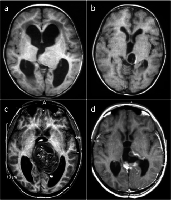 儿童丘脑浸润性胶质瘤:H3 K27M突变