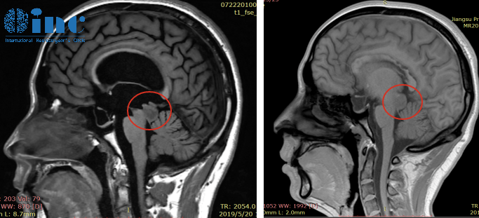 脑干肿瘤全切案例