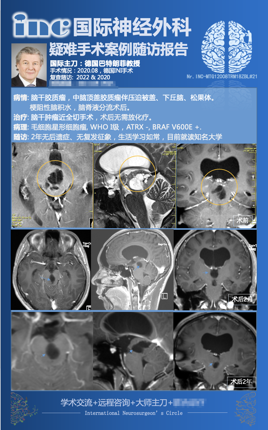 巴教授中脑顶盖胶质瘤