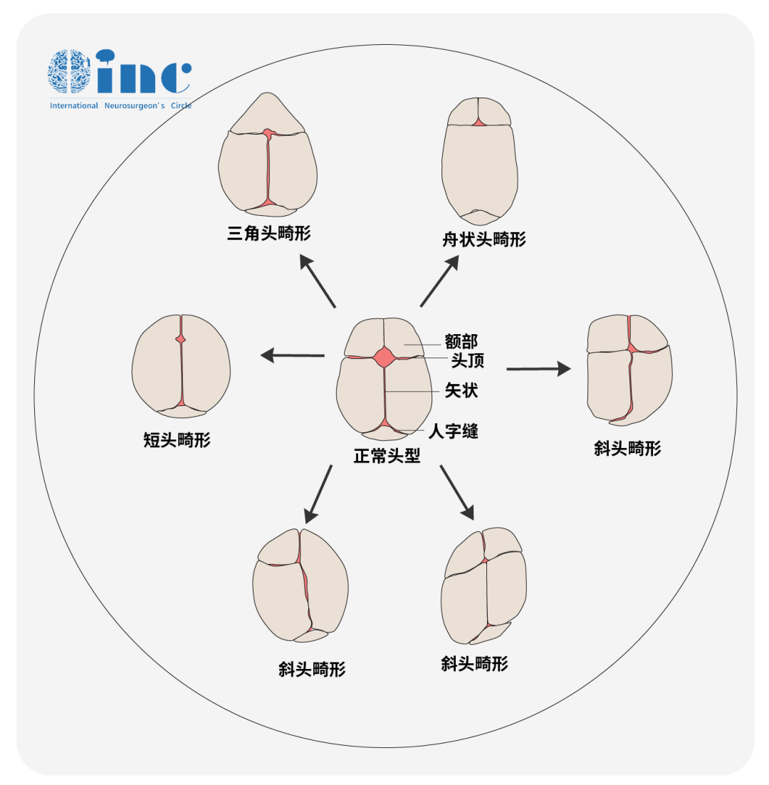 一侧冠状缝早闭图片图片