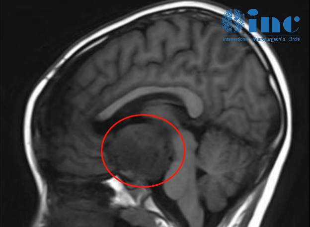 鞍区肿瘤都有哪些？手术难度大吗？INC巴教授9岁男孩鞍区肿瘤成功手术案例