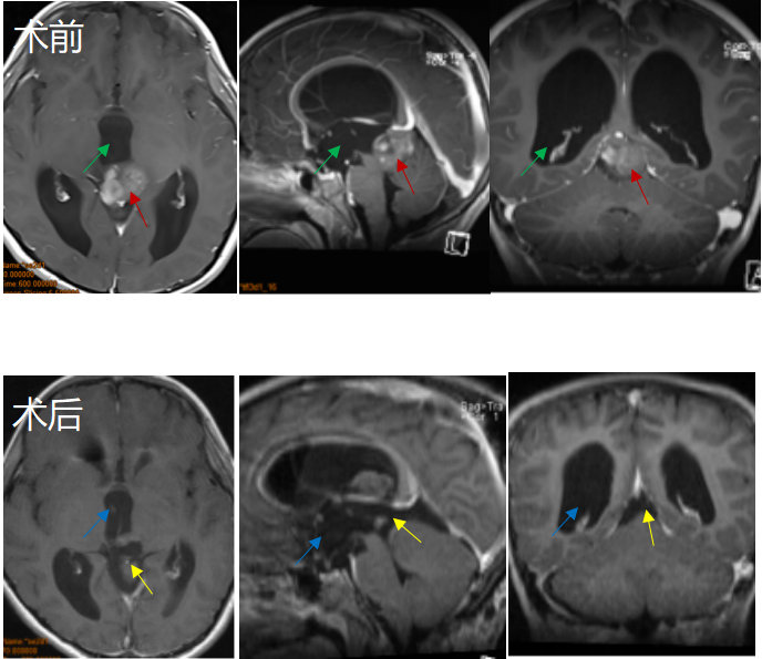 <a href='/songguotiliu/' target='_blank'><u>松果体肿瘤</u></a>案例