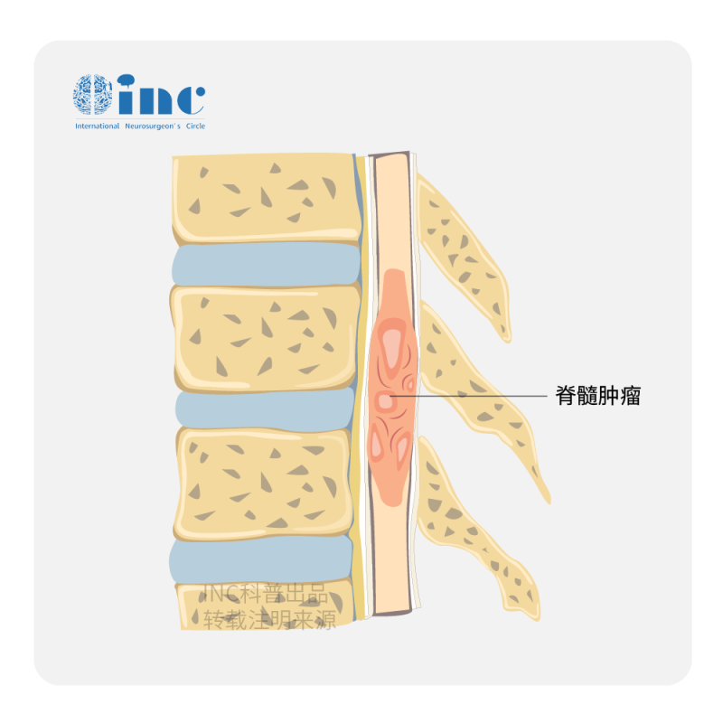 脊髓肿瘤