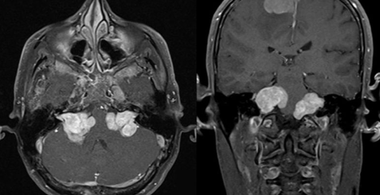 双侧听神经瘤