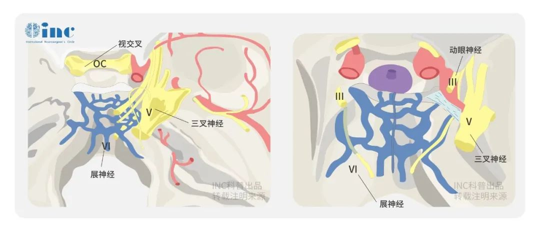 CPA区脑膜瘤侵犯内听道手术全切、不面瘫、不耳聋的关键是什么？