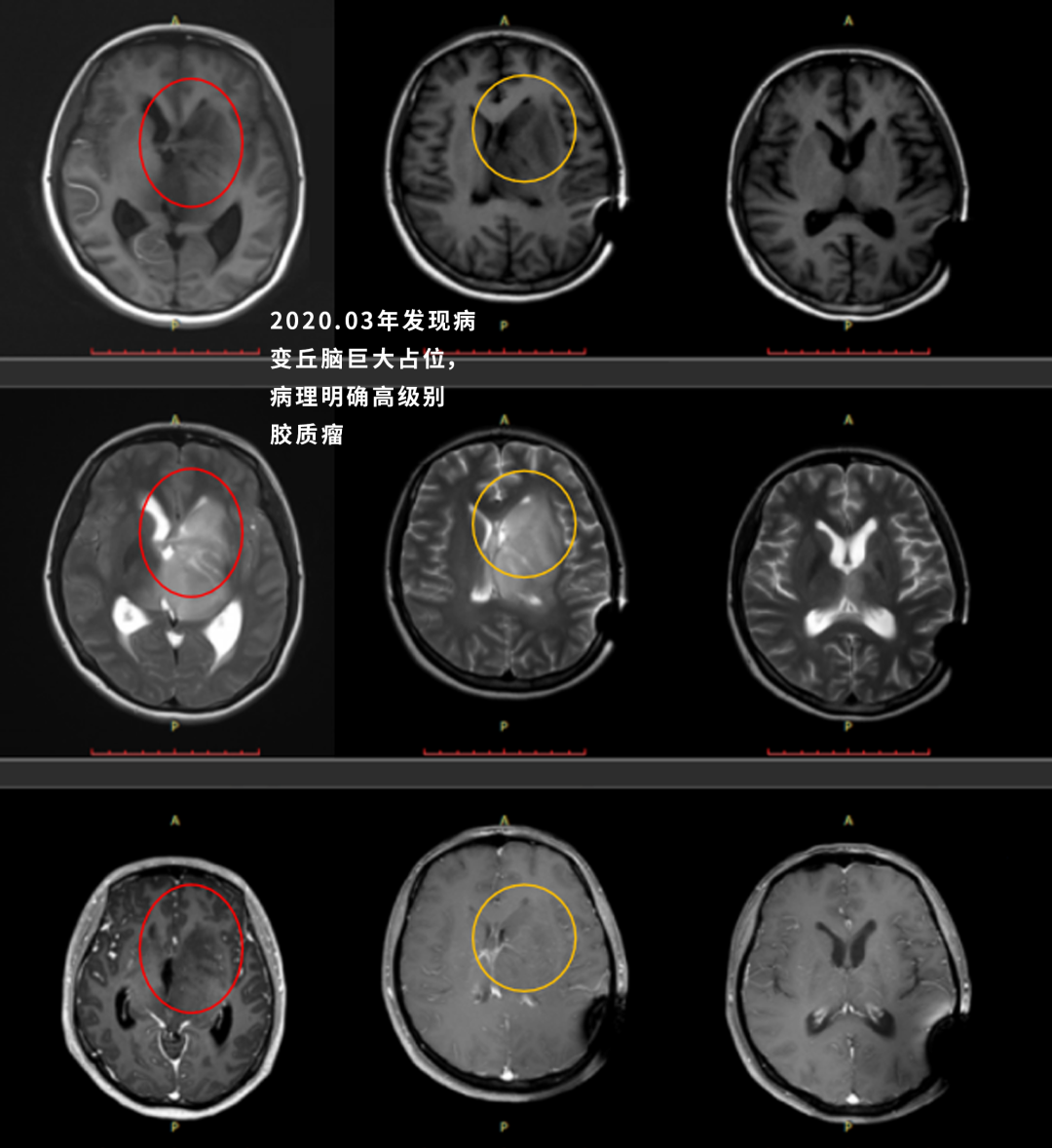 丘脑肿瘤有可能安全切除吗？三个丘脑肿瘤手术案例分享