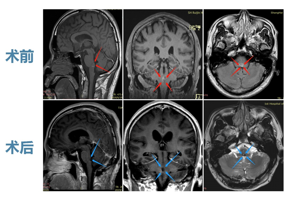 脑干海绵状血管瘤
