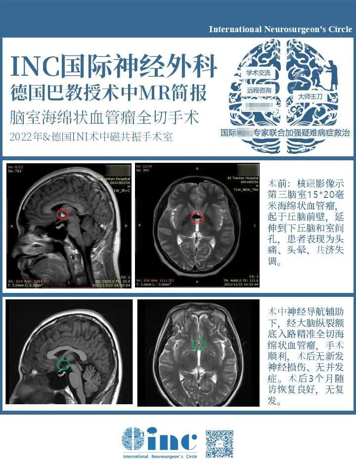 脑室海绵状血管瘤