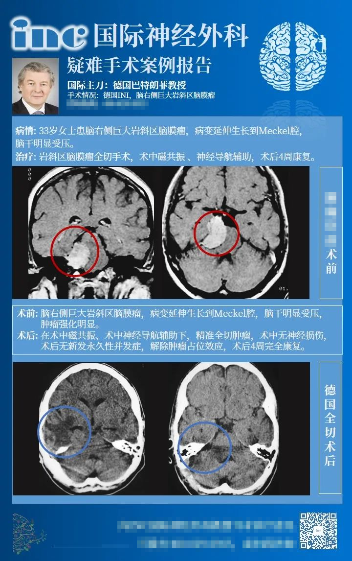 岩斜区脑膜瘤手术六大难点有哪些？看INC国际教授如何攻破